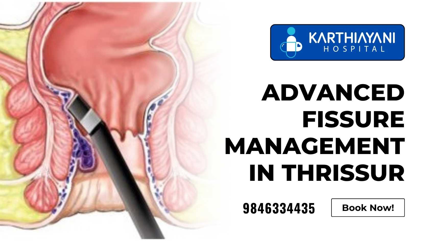 Advanced fissure treatment at Karthiayani Hospital in Thrissur